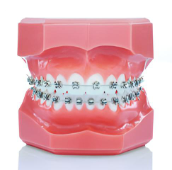 Manipulative model of teeth and gums with braces on it.